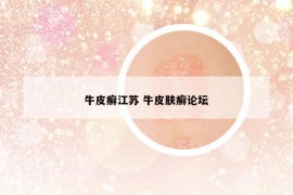 牛皮癣江苏 牛皮肤癣论坛