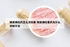 银屑病吃药怎么没效果 银屑病吃着药为什么控制不住