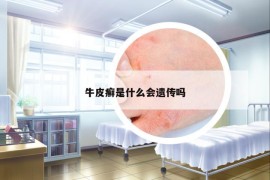 牛皮癣是什么会遗传吗