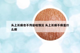 头上长癣也不传染啥情况 头上长癣不痒是什么癣