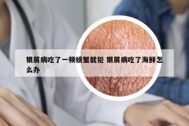 银屑病吃了一顿螃蟹就犯 银屑病吃了海鲜怎么办