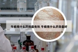 牛癣用什么药擦最有效 牛癣用什么药膏最好