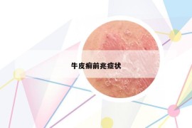 牛皮癣前兆症状