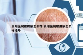 贵阳医院银屑病怎么样 贵阳医院银屑病怎么样挂号