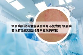 银屑病有没有治愈以后终身不复发的 银屑病有没有治愈以后终身不复发的可能