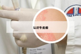认识牛皮癣