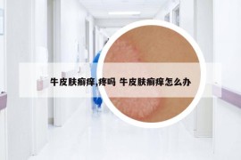 牛皮肤癣痒,疼吗 牛皮肤癣痒怎么办