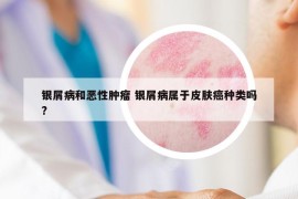银屑病和恶性肿瘤 银屑病属于皮肤癌种类吗?
