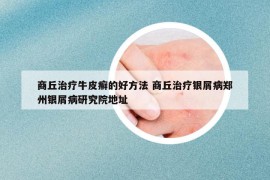 商丘治疗牛皮癣的好方法 商丘治疗银屑病郑州银屑病研究院地址