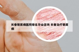 长春银屑病医院排名华山咨询 长春治疗银屑病