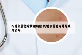 枸地氯雷他定片银屑病 枸地氯雷他定片是止痒的吗