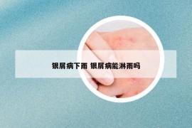 银屑病下雨 银屑病能淋雨吗