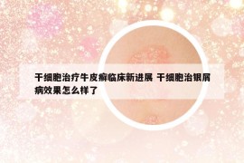 干细胞治疗牛皮癣临床新进展 干细胞治银屑病效果怎么样了