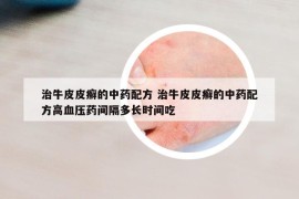 治牛皮皮癣的中药配方 治牛皮皮癣的中药配方高血压药间隔多长时间吃