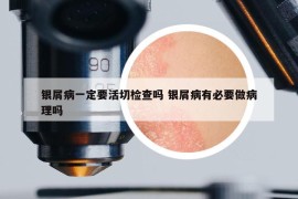 银屑病一定要活切检查吗 银屑病有必要做病理吗