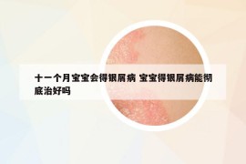 十一个月宝宝会得银屑病 宝宝得银屑病能彻底治好吗