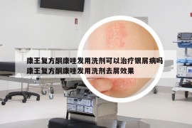 康王复方酮康唑发用洗剂可以治疗银屑病吗 康王复方酮康唑发用洗剂去屑效果