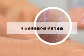 牛皮癣清除机介绍 铲除牛皮癣