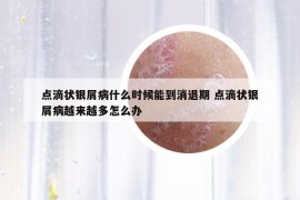 点滴状银屑病什么时候能到消退期 点滴状银屑病越来越多怎么办