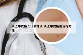 头上牛皮癣长什么样子 头上牛皮癣的治疗方法