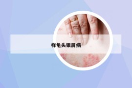 样龟头银屑病