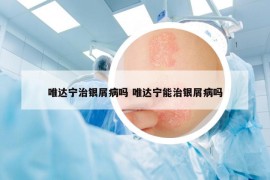 唯达宁治银屑病吗 唯达宁能治银屑病吗