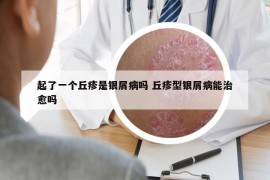 起了一个丘疹是银屑病吗 丘疹型银屑病能治愈吗