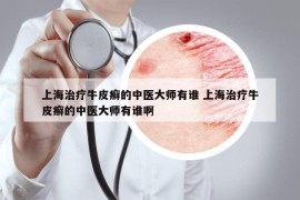 上海治疗牛皮癣的中医大师有谁 上海治疗牛皮癣的中医大师有谁啊