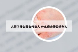 人得了什么藓会传染人 什么癣会传染给别人