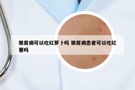 银屑病可以吃红萝卜吗 银屑病患者可以吃红薯吗