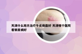 天津什么地方治疗牛皮癣最好 天津哪个医院看银屑病好