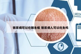 银屑病可以吃鳗鱼嘛 银屑病人可以吃鱼吗