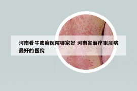 河南看牛皮癣医院哪家好 河南省治疗银屑病最好的医院