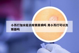 小苏打加水能去除银屑病吗 用小苏打可以洗银器吗