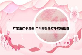 广东治疗牛皮癣 广州哪里治疗牛皮癣医院