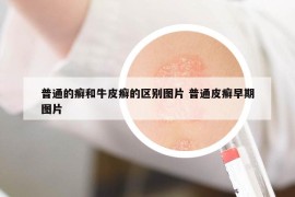 普通的癣和牛皮癣的区别图片 普通皮癣早期图片