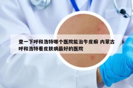 查一下呼和浩特哪个医院能治牛皮癣 内蒙古呼和浩特看皮肤病最好的医院