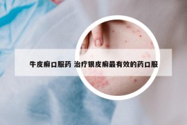 牛皮癣口服药 治疗银皮癣最有效的药口服
