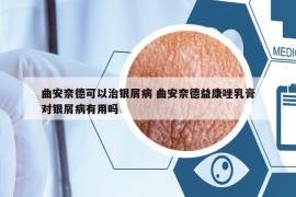 曲安奈德可以治银屑病 曲安奈德益康唑乳膏对银屑病有用吗