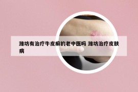 潍坊有治疗牛皮癣的老中医吗 潍坊治疗皮肤病