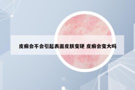皮癣会不会引起表面皮肤变硬 皮癣会变大吗