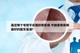 最近哪个电视节目播放银屑病 中国看银屑病最好的医生是谁?