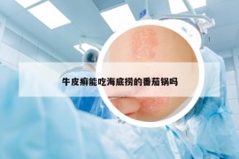 牛皮癣能吃海底捞的番茄锅吗
