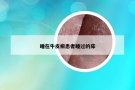 睡在牛皮癣患者睡过的床