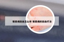 银屑病放血怎么样 银屑病的放血疗法