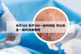 光疗308 光疗308一段时间后 可以休息一段时间再照吗
