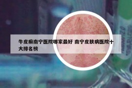 牛皮癣南宁医院哪家最好 南宁皮肤病医院十大排名榜