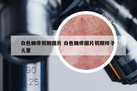 白色糠疹初期图片 白色糠疹图片初期样子 儿童