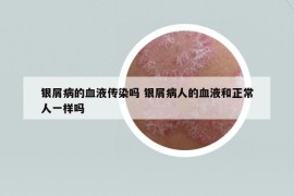 银屑病的血液传染吗 银屑病人的血液和正常人一样吗