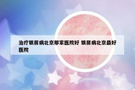 治疗银屑病北京那家医院好 银屑病北京最好医院